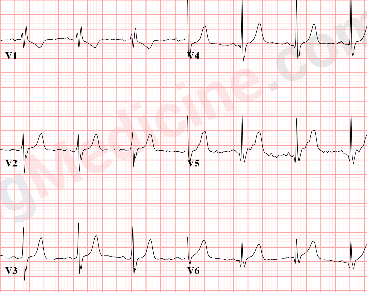 peaked-t-waves